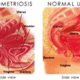 endometriosi.gif